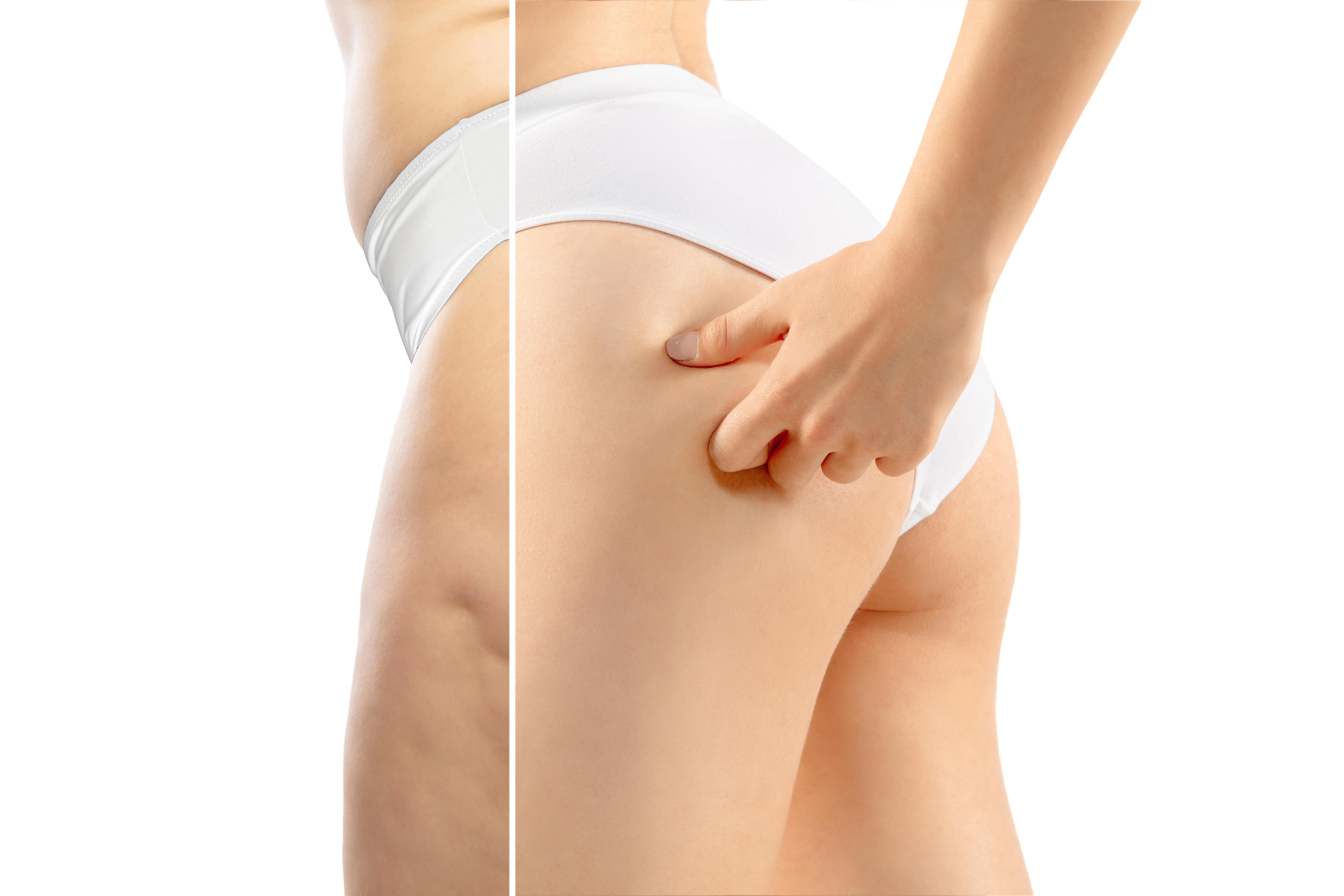 cellulite-reduction-in-altamonte-springs-fl