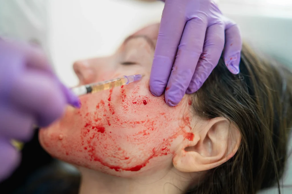 vampire-facial-altamonte-springs-fl-prp-skin-rejuvenation